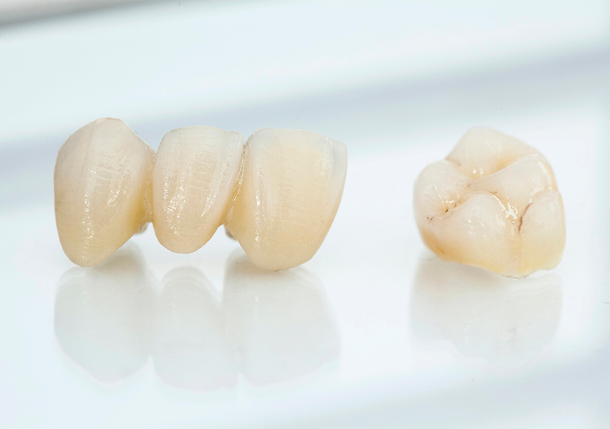 5 Reasons Why CEREC Same Day Crowns are Transforming Dental Care at Barsanti Dental Group