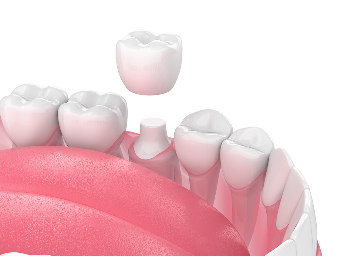 Broken Tooth? Top Reasons to Choose CEREC Crown Treatment