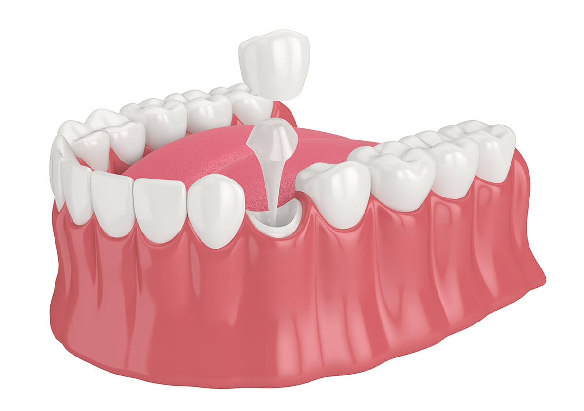 Dental Crowns, An Effective Decay and Dental Trauma Treatment