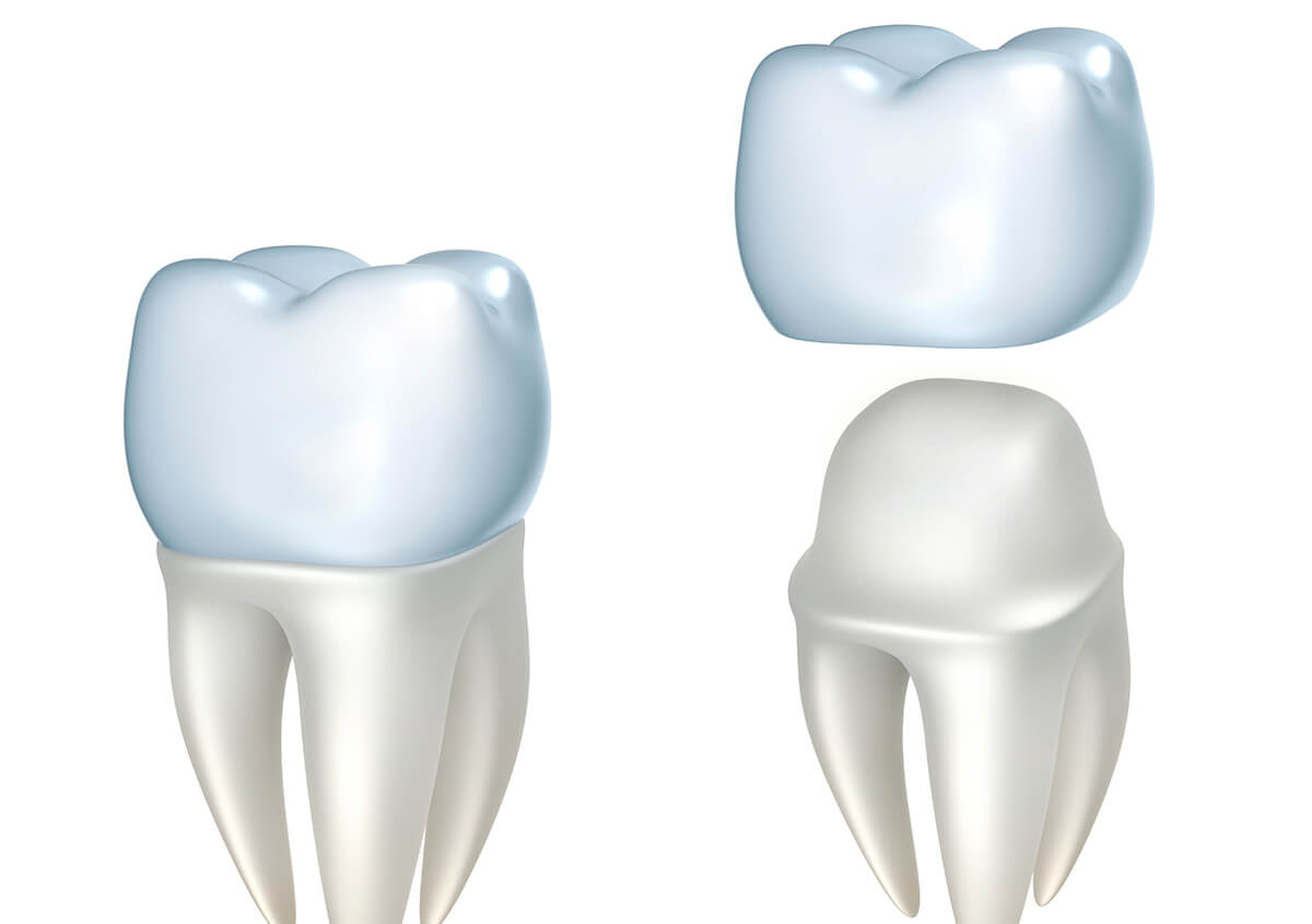 Reasons for Getting a Crown on Your Tooth