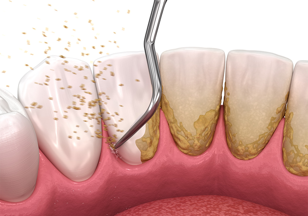 Gum Health: 5 Facts You Must Know About Gum Disease
