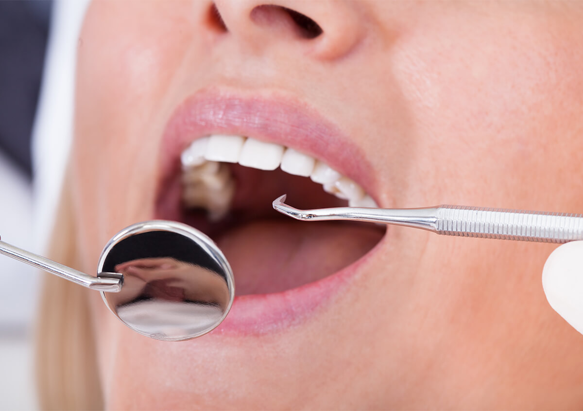 Composite Fillings Restore the Look and Function of Your Smile